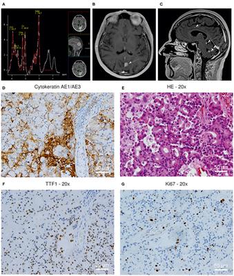 Case Report: Findings Suggestive of Paraclinical Progressive Multifocal Leukoencephalopathy and Lung Cancer-Derived Brain Metastases in an MS Patient Treated With Fingolimod